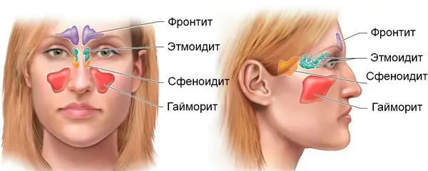 Causes, signs and symptoms of sinusitis