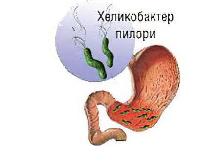 Causes, signs and symptoms of stomach gastritis