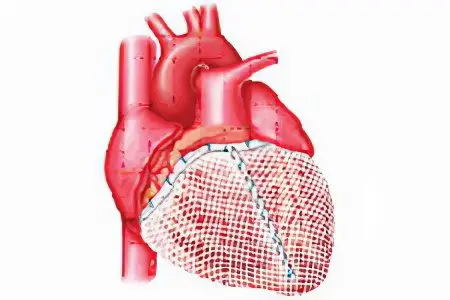 Causes, signs and symptoms of ventricular hypertrophy