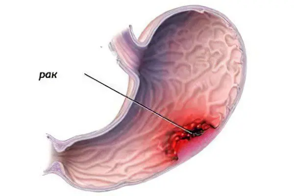 Causes, signs, symptoms and treatment of stomach cancer