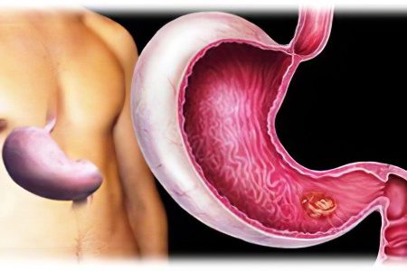 Causes, signs, symptoms and treatment of stomach cancer