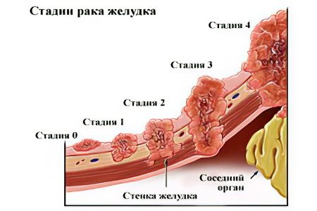 Causes, signs, symptoms and treatment of stomach cancer