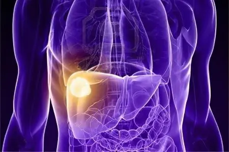 Causes, signs, symptoms, stages and treatment of liver cancer