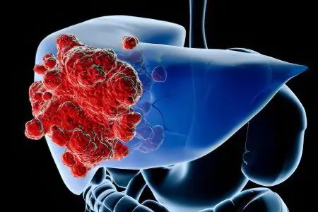 Causes, signs, symptoms, stages and treatment of liver cancer