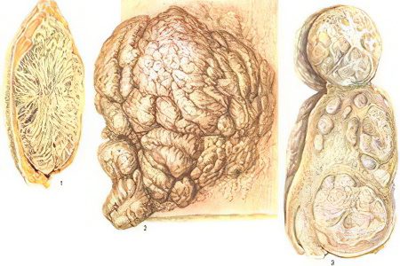 Causes, stages, types and treatment of a benign tumor