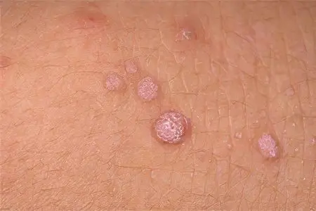 Causes, stages, types and treatment of a benign tumor
