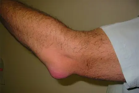 Causes, symptoms and complications of bursitis