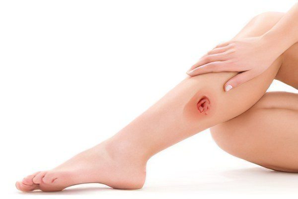 Causes, symptoms and how to treat trophic ulcers on the legs?