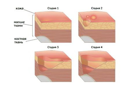 Causes, symptoms and how to treat trophic ulcers on the legs?