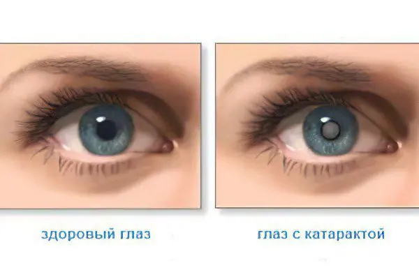 Causes, symptoms and prevention of cataracts, eye drops