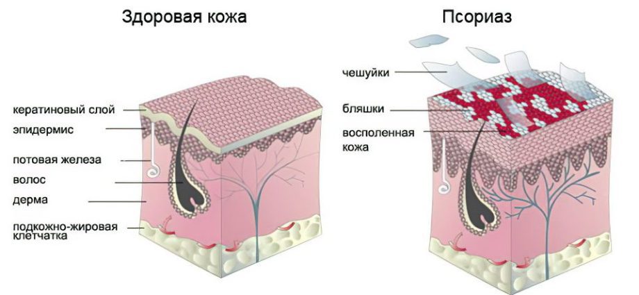 Causes, symptoms and stages of psoriasis