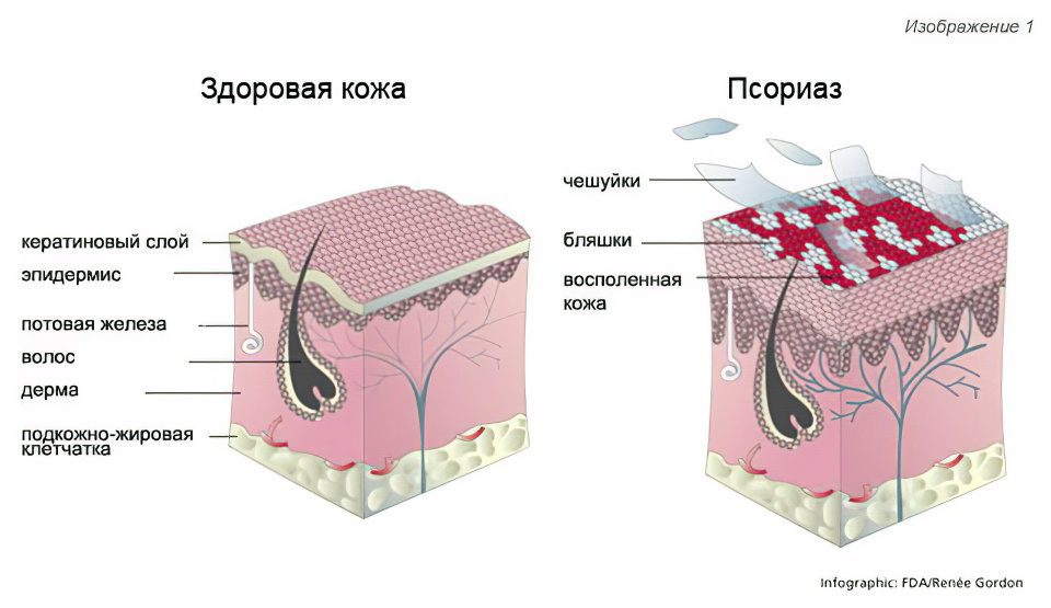 Causes, symptoms and stages of psoriasis