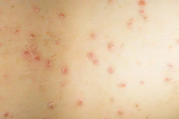 Causes, symptoms and stages of psoriasis