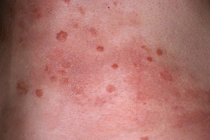 Causes, symptoms and stages of psoriasis