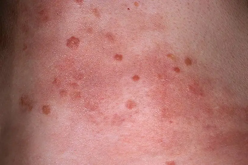 Causes, symptoms and stages of psoriasis