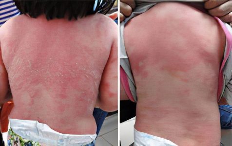 Causes, symptoms and stages of psoriasis