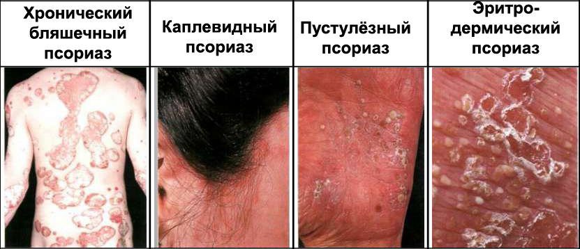 Causes, symptoms and stages of psoriasis