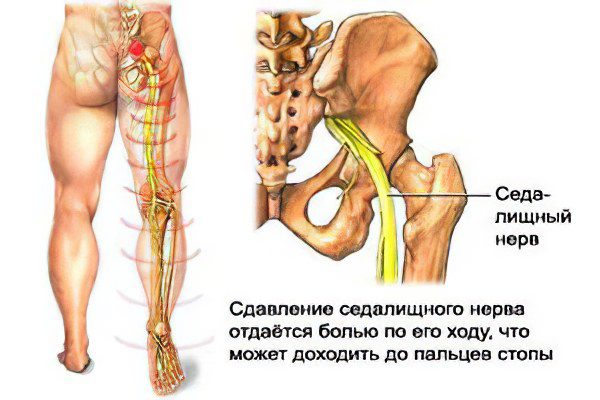 Causes, symptoms and treatment of a pinched nerve