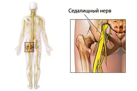 Causes, symptoms and treatment of a pinched sciatic nerve