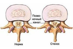 Causes, symptoms and treatment of a pinched sciatic nerve