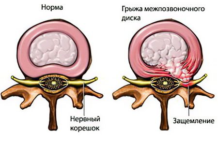 Causes, symptoms and treatment of a pinched sciatic nerve