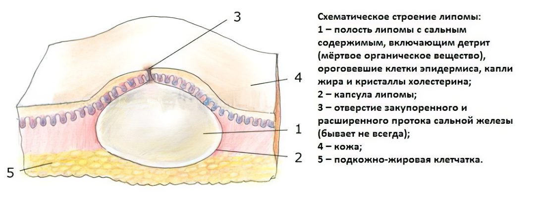 Causes, symptoms and treatment of a wen