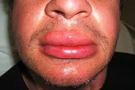 Causes, symptoms and treatment of angioedema