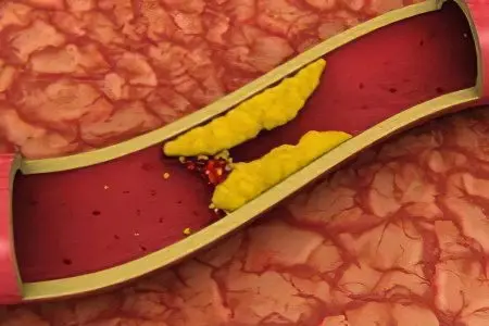 Causes, symptoms and treatment of aortic sclerosis