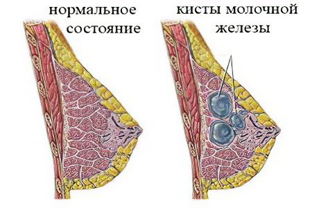 Causes, symptoms and treatment of breast cysts