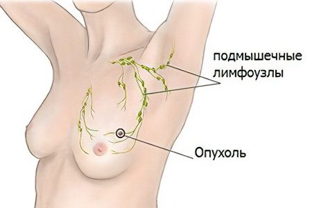 Causes, symptoms and treatment of breast cysts