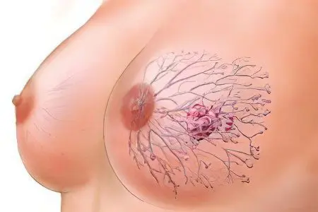 Causes, symptoms and treatment of breast cysts