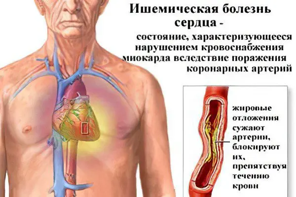 Causes, symptoms and treatment of cardiac ischemia