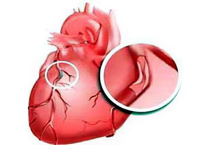 Causes, symptoms and treatment of cardiac ischemia