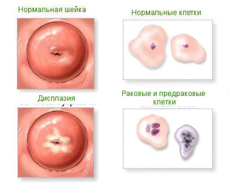 Causes, symptoms and treatment of cervical dysplasia