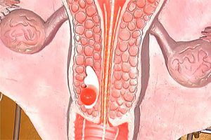 Causes, symptoms and treatment of cervical dysplasia