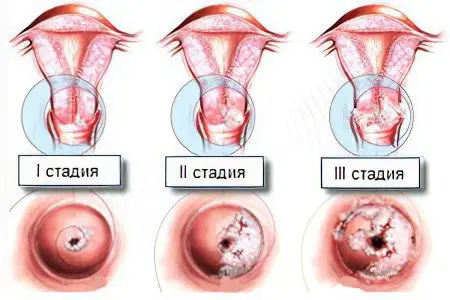 Causes, symptoms and treatment of cervical dysplasia