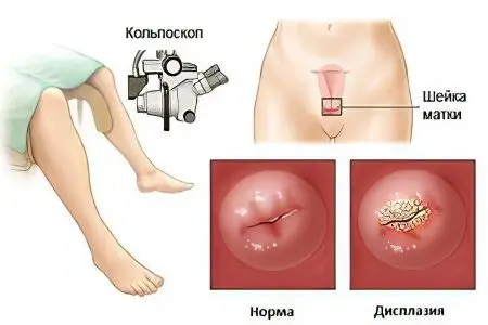 Causes, symptoms and treatment of cervical dysplasia