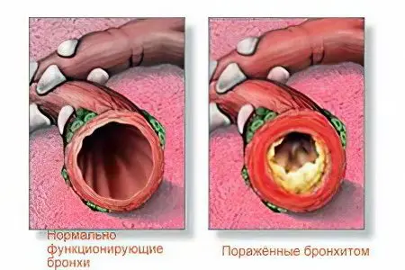 Causes, symptoms and treatment of chronic bronchitis