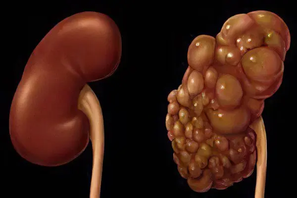 Causes, symptoms and treatment of cysts of the right and left kidney