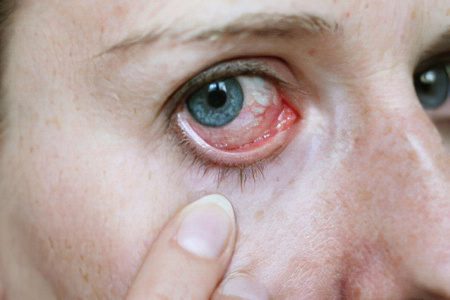 Causes, symptoms and treatment of eye cancer