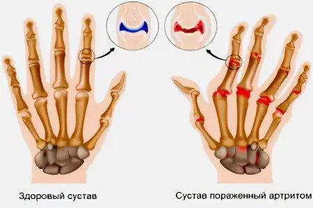 Causes, symptoms and treatment of finger arthritis