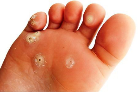 Causes, symptoms and treatment of foot fungus