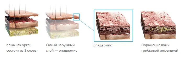 Causes, symptoms and treatment of foot fungus