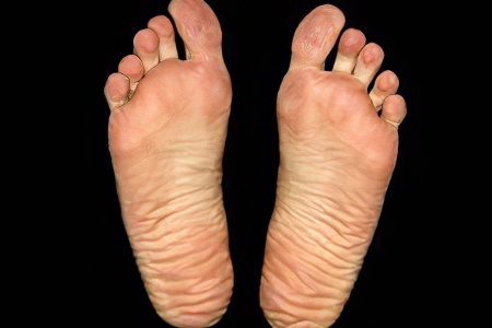 Causes, symptoms and treatment of foot fungus