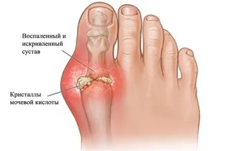 Causes, symptoms and treatment of gout on the legs