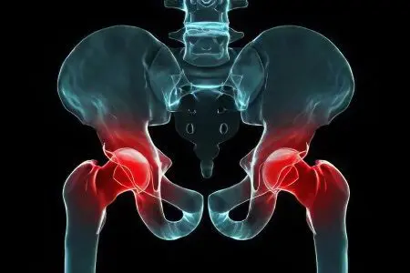 Causes, symptoms and treatment of hip arthritis