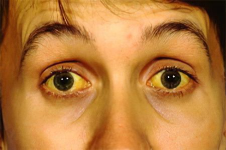 Causes, symptoms and treatment of jaundice in adults