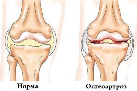 Causes, symptoms and treatment of osteoarthritis of the joints