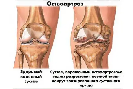 Causes, symptoms and treatment of osteoarthritis of the joints