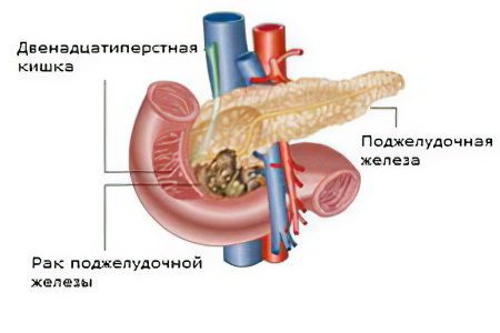 Causes, symptoms and treatment of pancreatic cancer